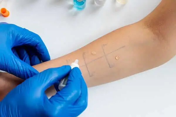 Pruebas de Alergia
